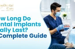 How Long Do Dental Implants Really Last?